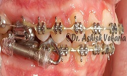 metal braces