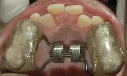 metal braces