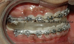 metal braces