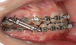 metal braces